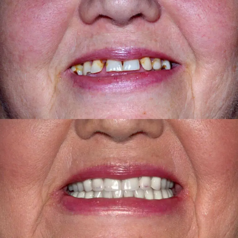 before and after all on 4 procedure
