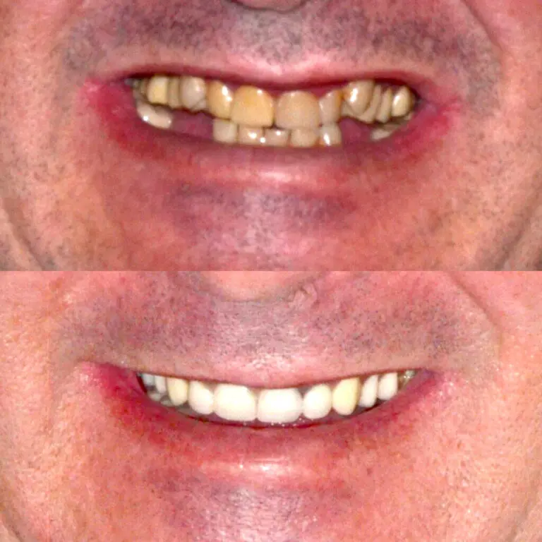 before and after all on 4 procedure