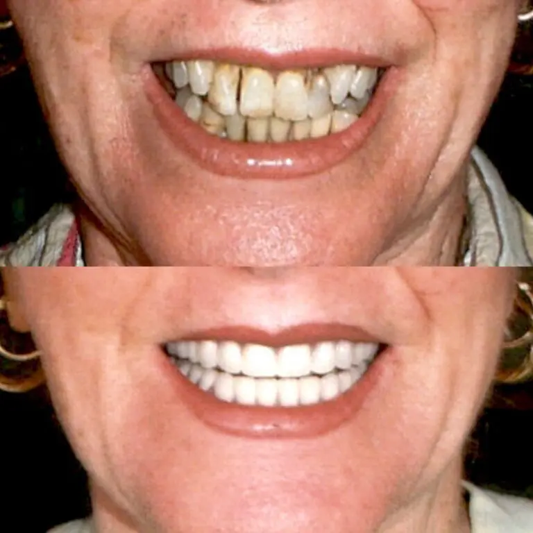 before and after all on 4 procedure