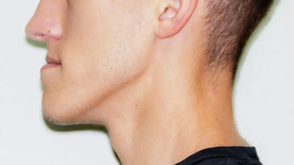 before jaw surgery image profile