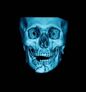 CT scan (computed tomography) of facial bone, anteroposterior (AP) view, showing mandibular fracture