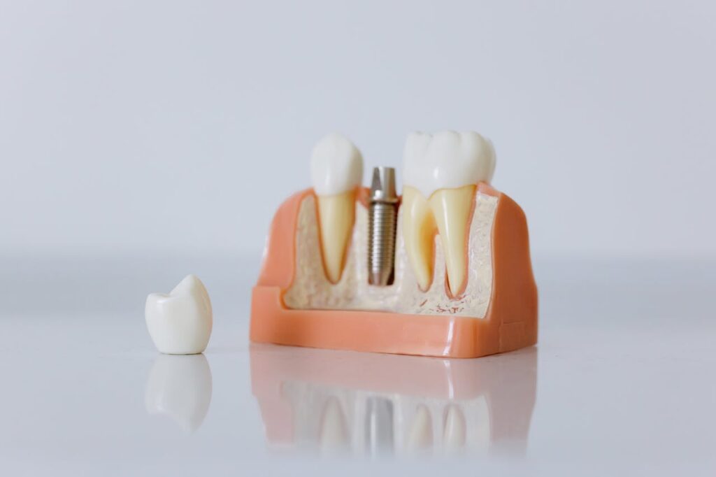 Photo by cottonbro studio: https://www.pexels.com/photo/close-up-shot-of-dental-implant-model-6502343/ - dental implant model demonstration