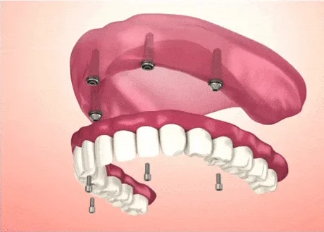 New Teeth Today model animation