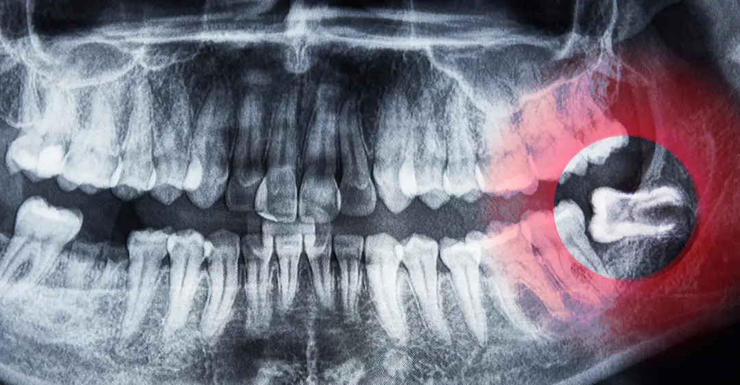 impacted wisdom teeth xray