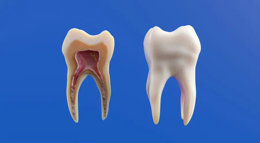 Illustration of an impacted wisdom tooth before surgical removal